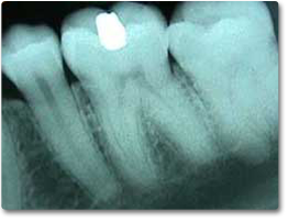 An x-ray image of teeth