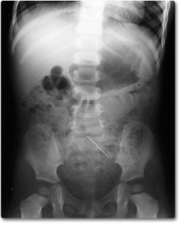 An X-ray photo of a one year old girl who swallowed a sewing pin